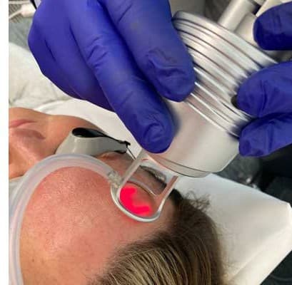CO2 fractional laser handpiece passing over the forehead, with the client’s eyes protected