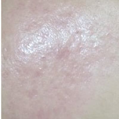Acne-prone skin — texture and redness improvement — after