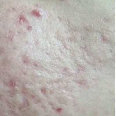 Acne-prone skin — texture and redness improvement — before