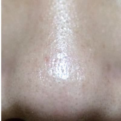 Pore reduction after CO2 laser resurfacing — after