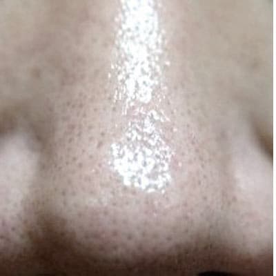 Pore reduction after CO2 laser resurfacing — before