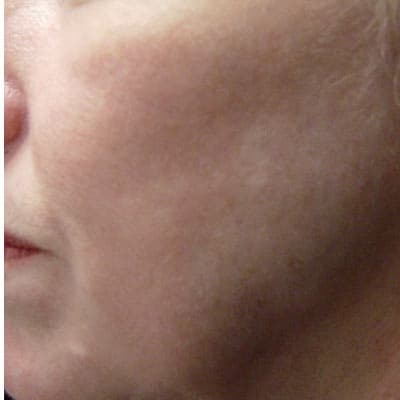 Skin rejuvenation — smoother texture and more even tone — after