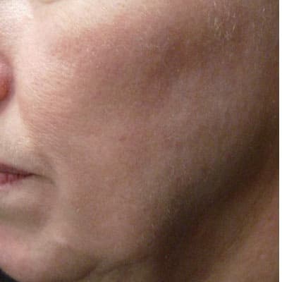Skin rejuvenation — smoother texture and more even tone — before