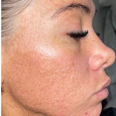 Genuine Skin Anatomy client with sun damage treated by CO2 laser resurfacing — after