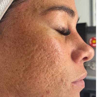 Genuine Skin Anatomy client with sun damage treated by CO2 laser resurfacing — before