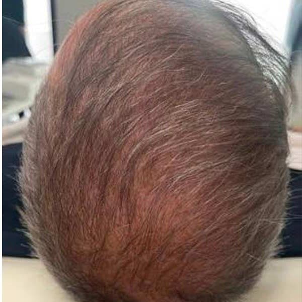 Thinning crown — E50 hair treatment — after