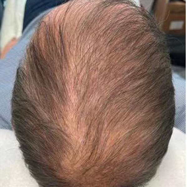 Thinning crown — E50 hair treatment — before