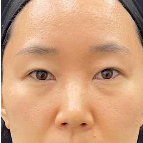Skin texture and visible pores — after