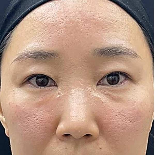 Skin texture and visible pores — before