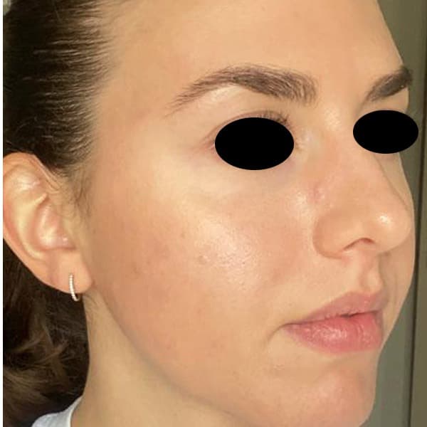 Blemish-prone skin and redness — after