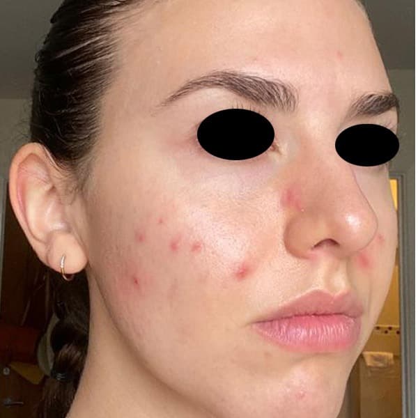 Blemish-prone skin and redness — before