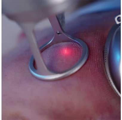 Laser beam guide light on the skin during treatment